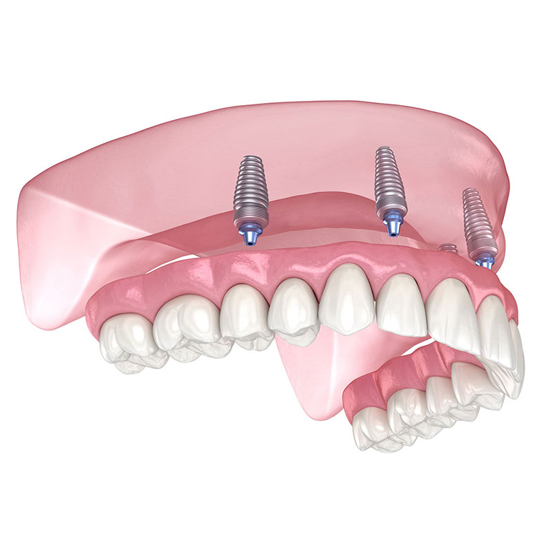 Removable dentures on implants at CustomFit Denture Clinic