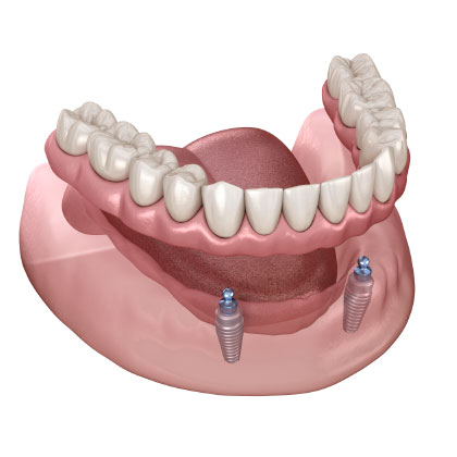 Removable dentures on implants at CustomFit Denture Clinic